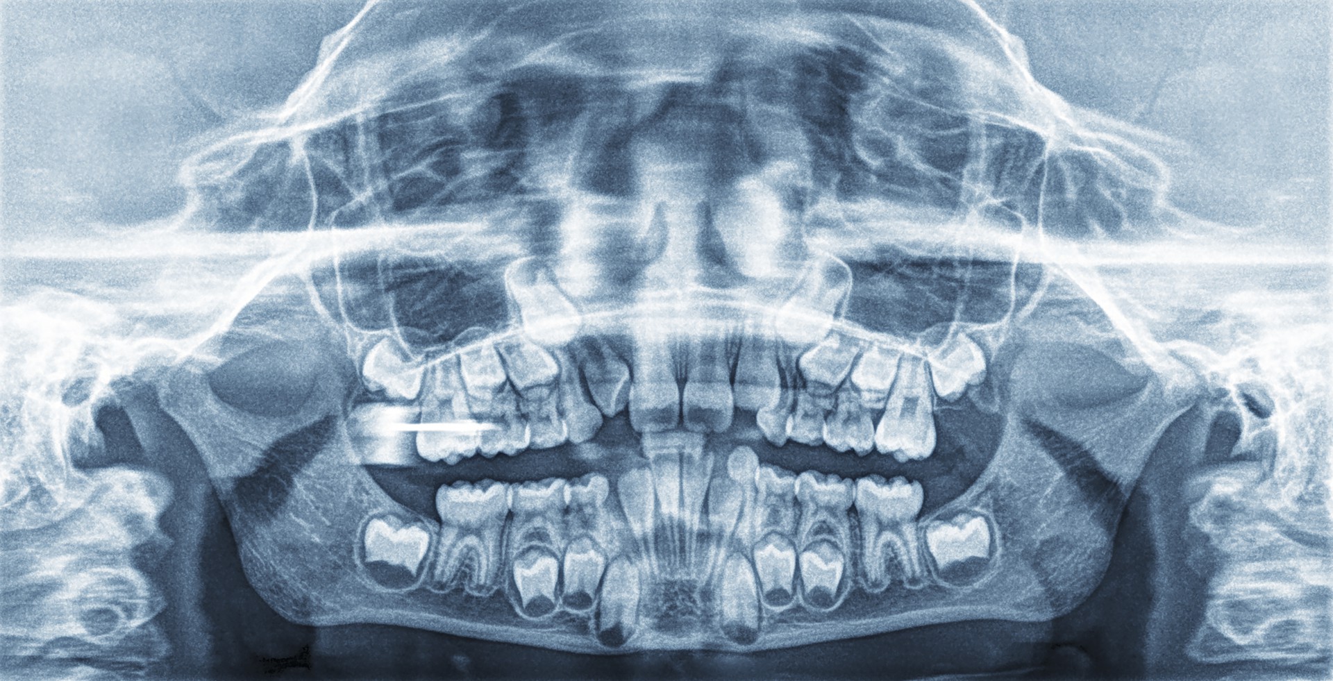 Детский череп рентген. Рентген зубов панорамный детский. Панорамные снимки зубов у детей.